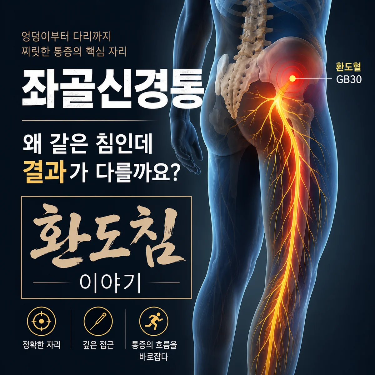 미금역한의원 환도혈, 환도침이란? 좌골신경통(하지방사통) 한방 치료의 핵심